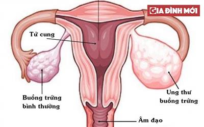 7 dấu hiệu cảnh báo ung thư buồng trứng
