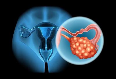 Ung thư buồng trứng nguy hiểm không?