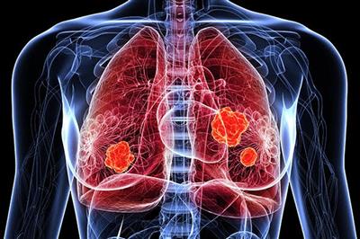 Người bị ung thư phổi nên ăn gì và kiêng gì?